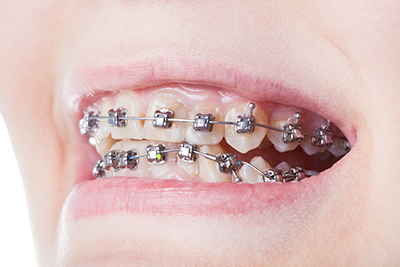 girl with orthodontic braces