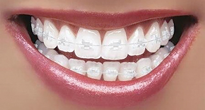 girl with orthodontic braces