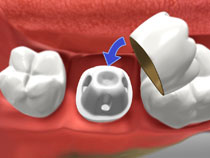 dental crown diagram 