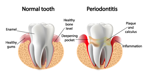 periodontics in ne calgary