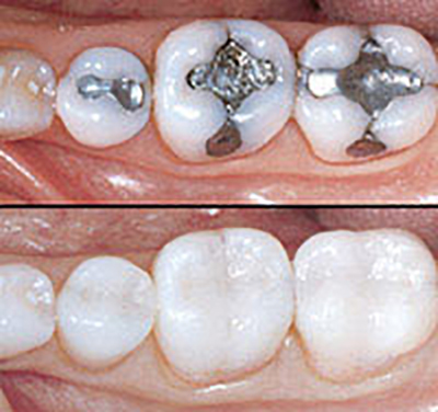 photo of Tooth Coloured Fillings before and after results