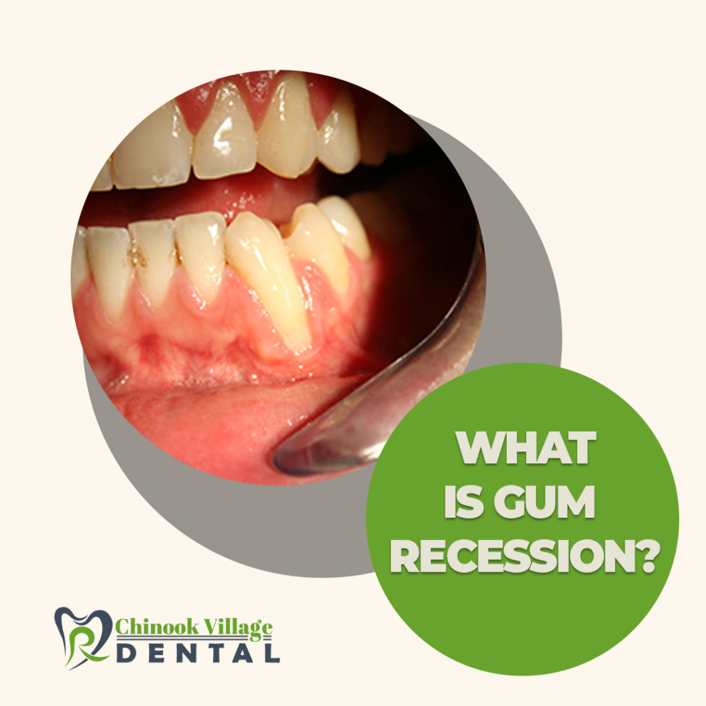  Gum Recession: Causes, Prevention & Treatment 